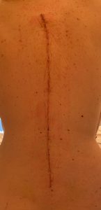Cicatrice après chirurgie de scoliose dégénérative